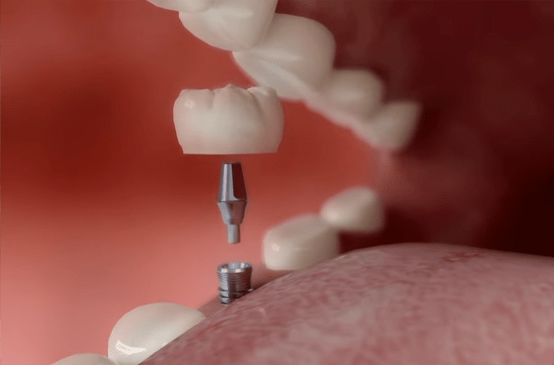 implantátum, fogpótlás - Medical Center Hatvan, fogászat, fogászat Hatvan, fog implantátum, implantátum Hatvan, fogpótlás Hatvanban