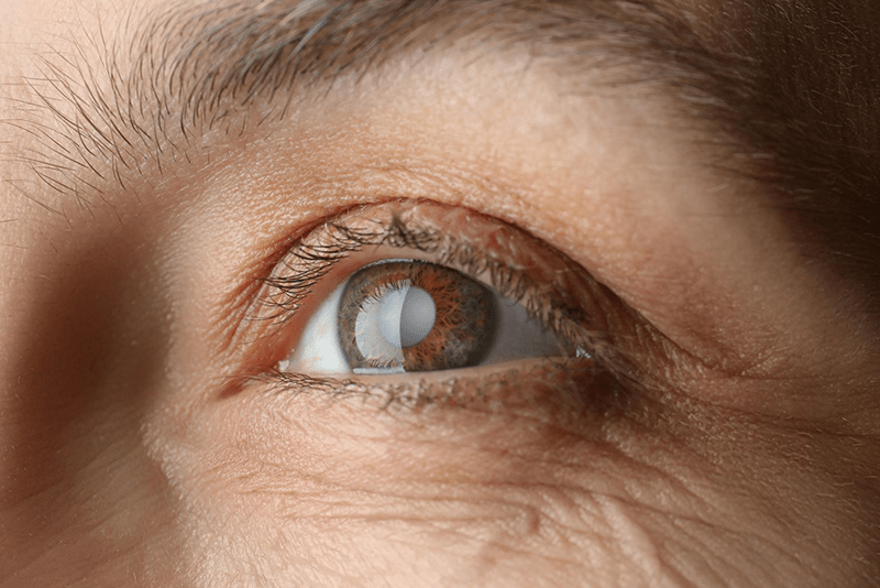 Szürkehályog - Medical Center Hatvan, szembetegség kezelése