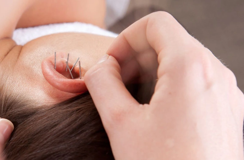 Fülakupunktúra - apró tűk, nagy hatás blog - MC60