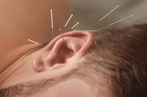Ön tudja, hogy mi az a fülakupunktúra? - MC60