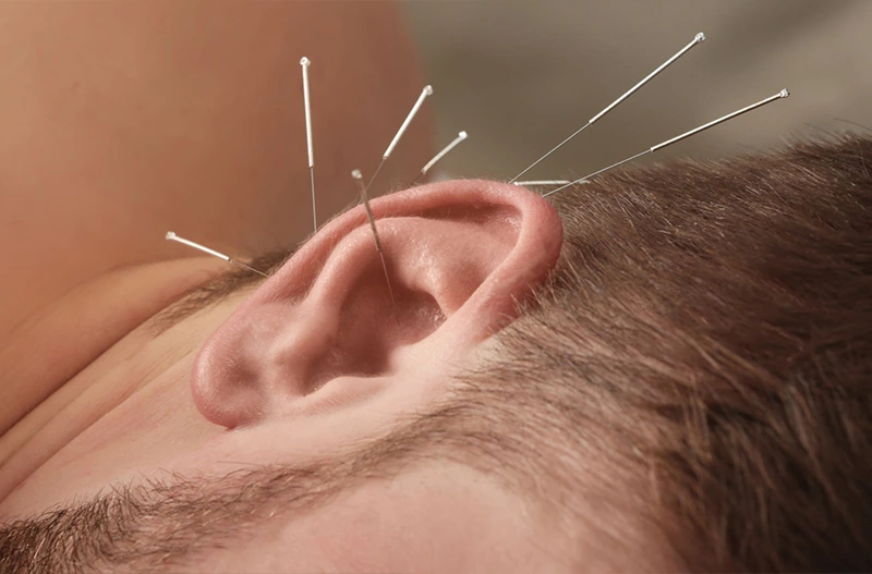 Ön tudja, hogy mi az a fülakupunktúra? - MC60